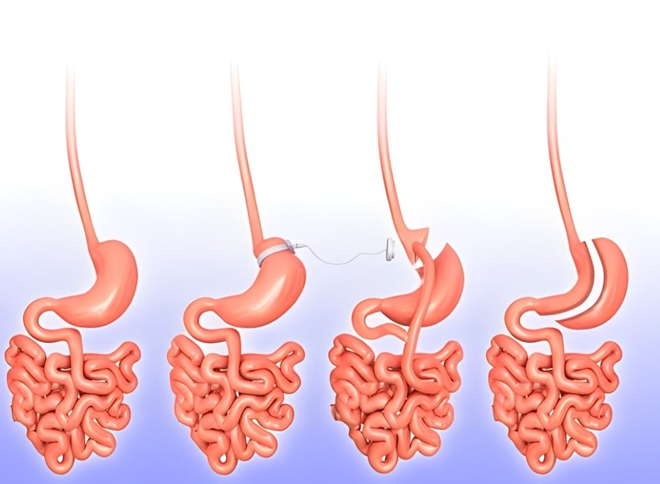 Laparoscopic Bariatric Surgery