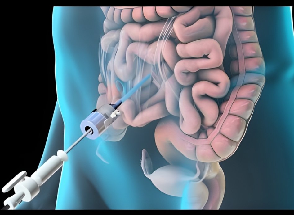 Laparoscopic Colorectal Surgery