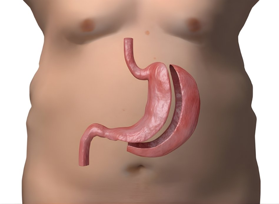 Sleeve Gastrectomy
