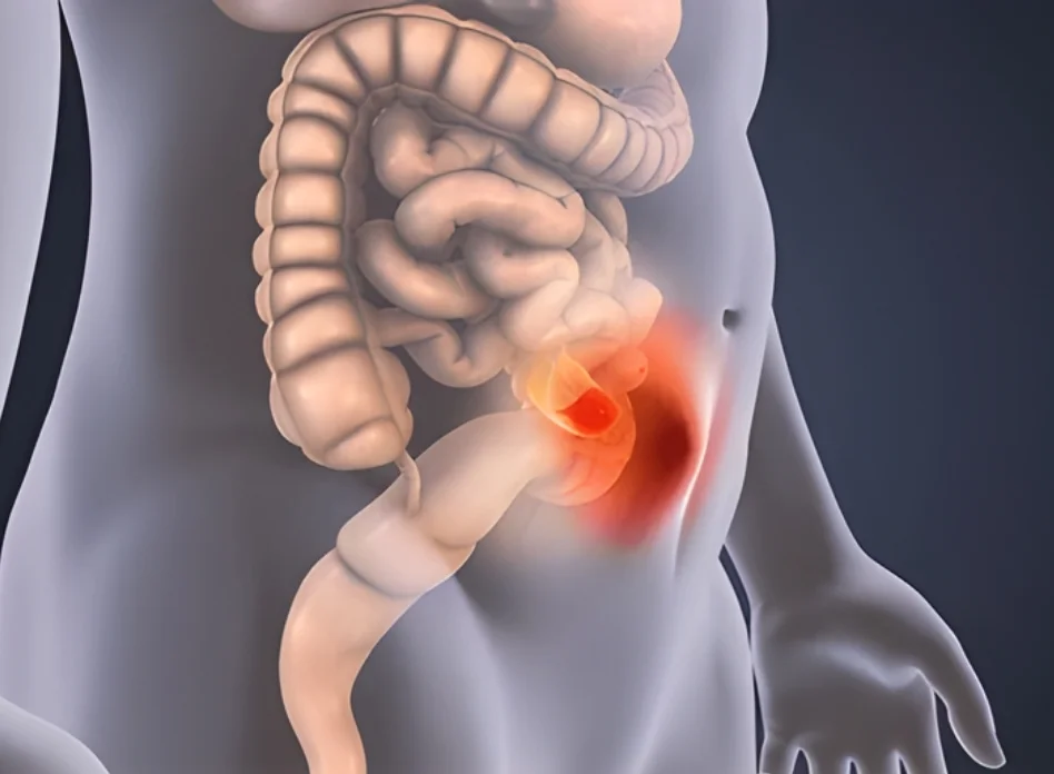 Complex Hernia & Perineal Surgery