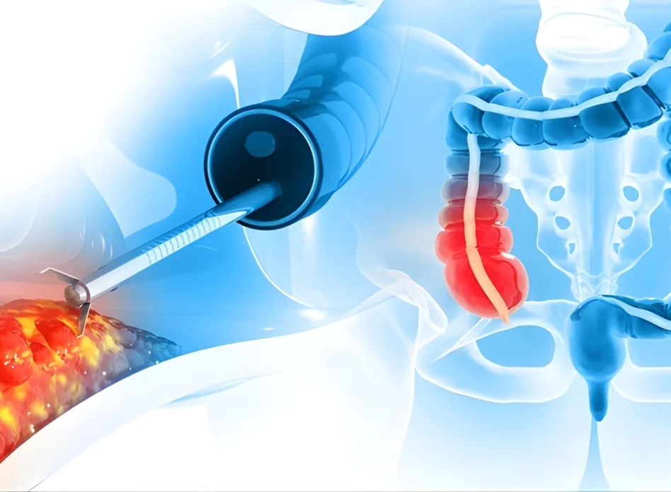 Robotic Colorectal Surgery