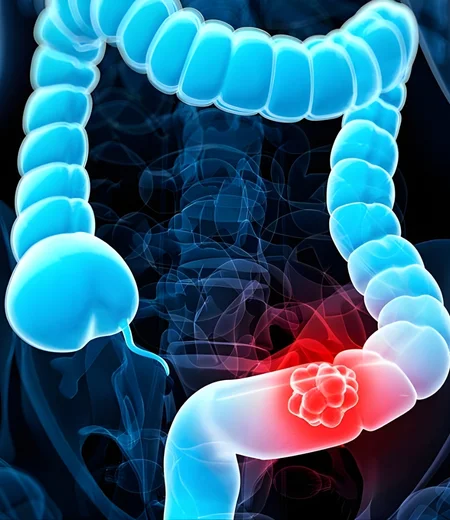 Colon Cancer Treatment