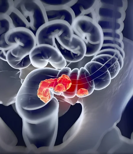 rectum cancer treatment