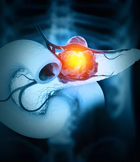 Pancreatic cancer surgery