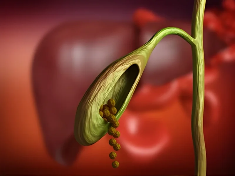 risk factor for gallbladder cancer