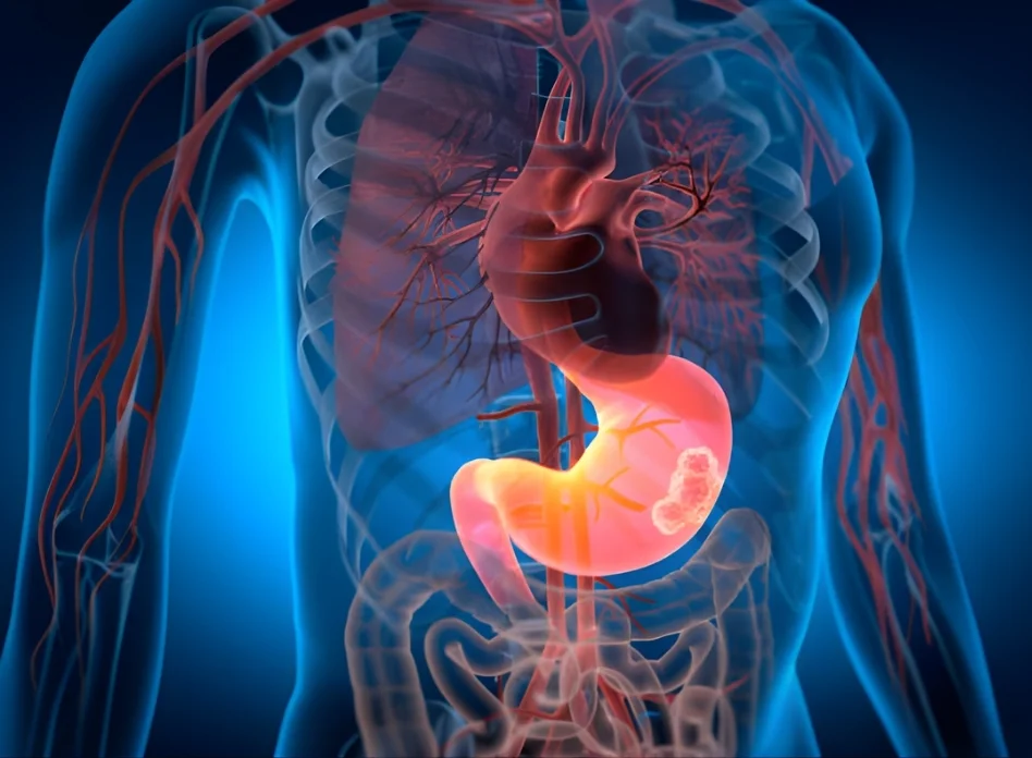 Stomach Cancer Surgery