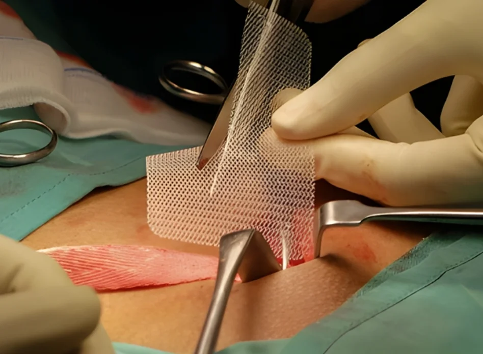 Mesh Repair Techniques