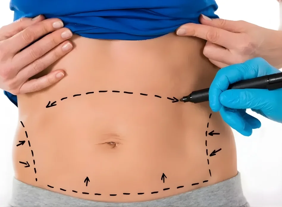 Complex Abdominal Wall Reconstruction