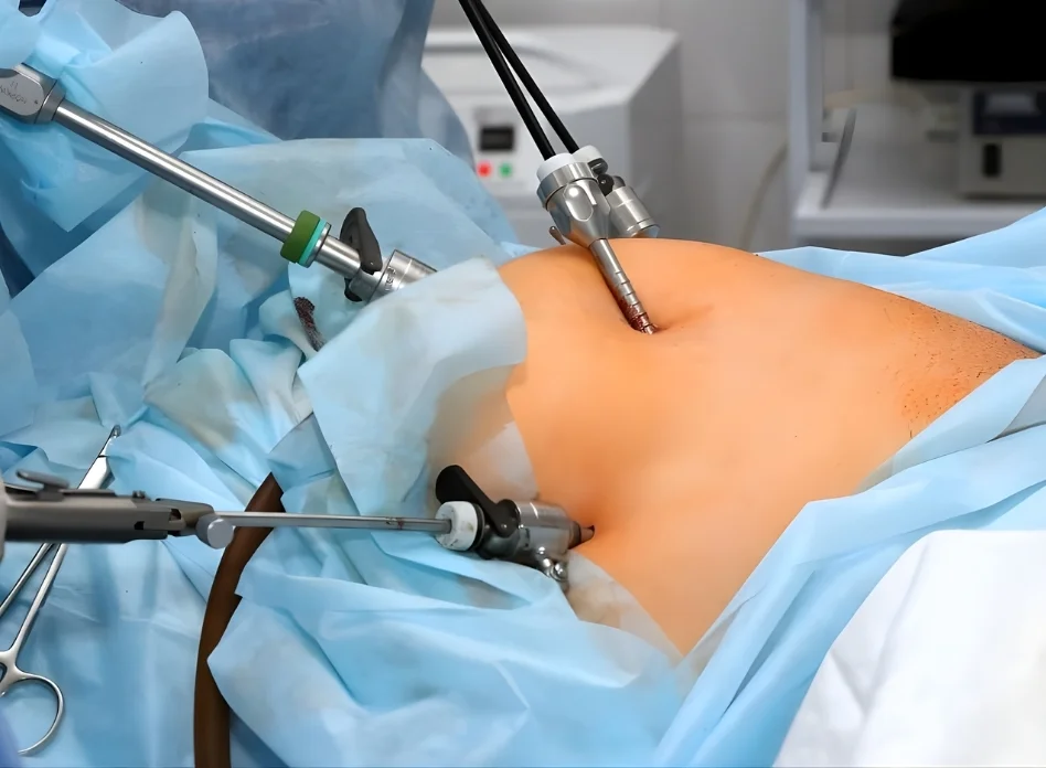 Recurrent Hernia Surgery