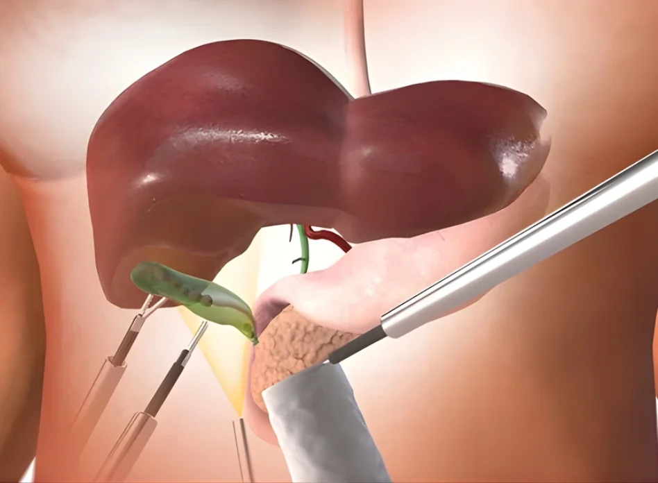 Laparoscopic Gallbladder Surgery