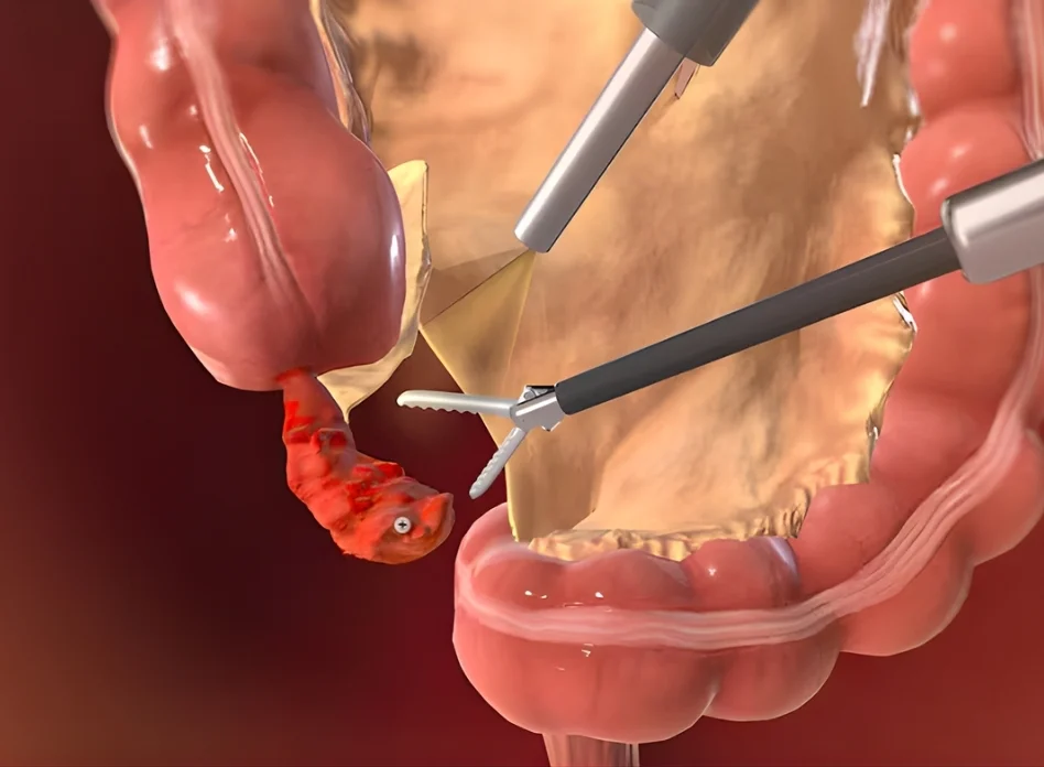 Laparoscopic Appendectomy