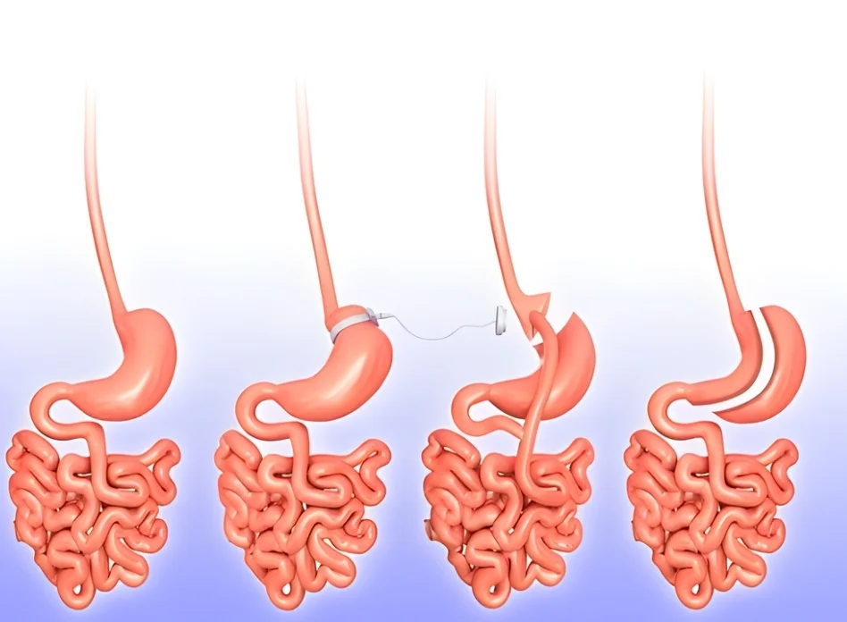 Robotic Bariatric Surgery