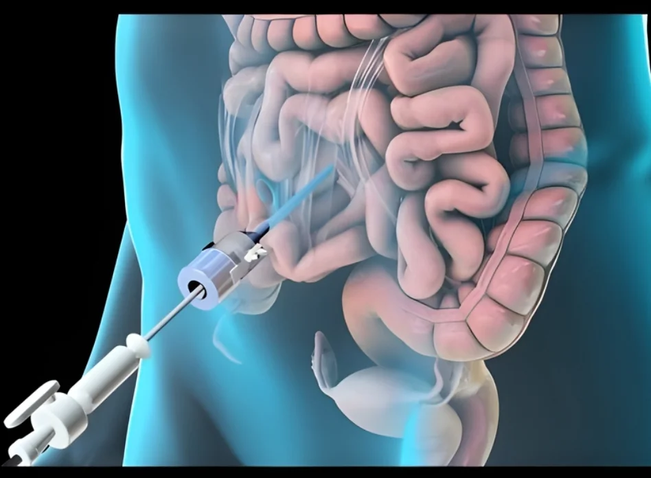 Laparoscopic Colorectal Surgery