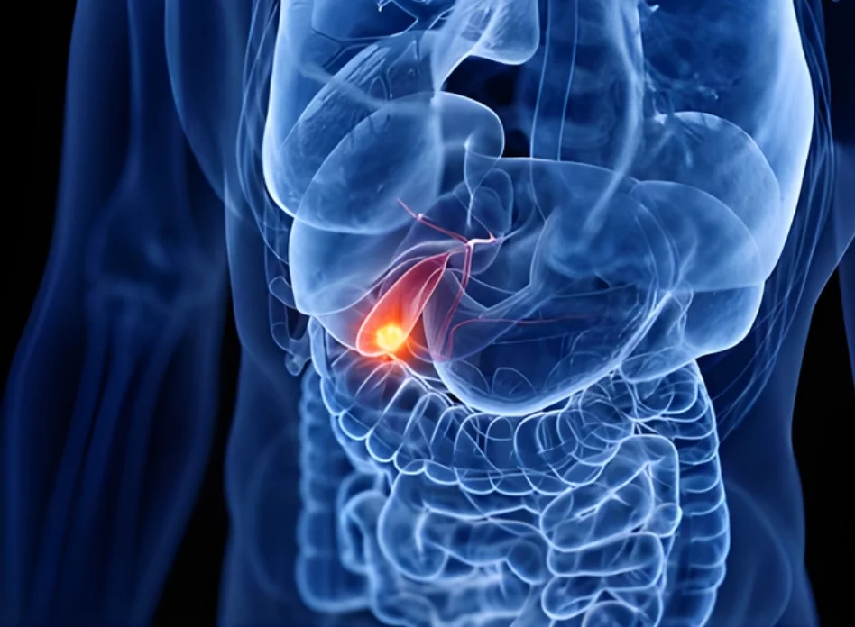 Gallbladder Cancer Surgery