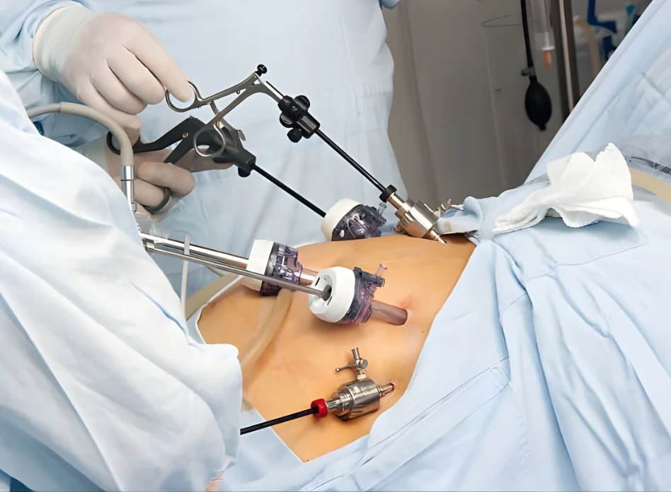 Gastric Bypass Surgery