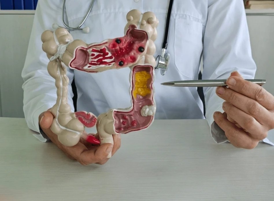 Rectum Cancer Surgery 